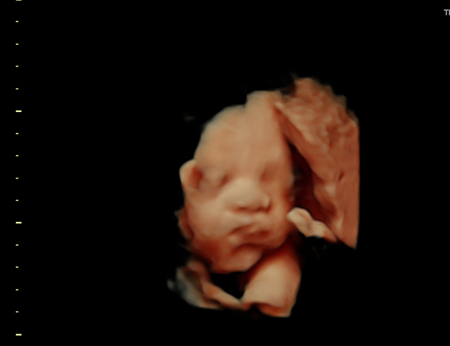3D ultrasound image at 29 weeks
